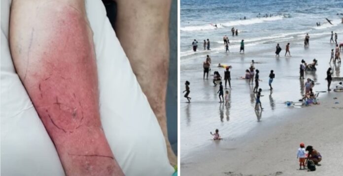 Deadly Beach Bacteria Rapidly Spreads Across U.S